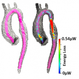 4D MRI Virtual Catheter (vCath)